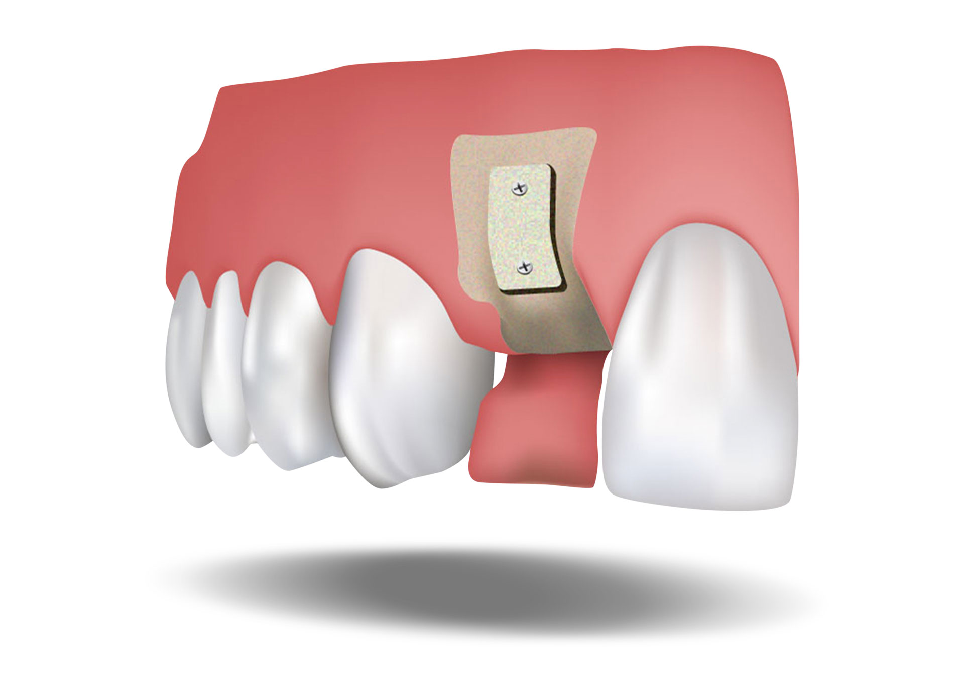 bone loss dental implants