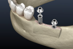 dental bone grafting