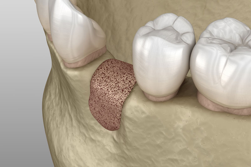 jawbone loss dental implants