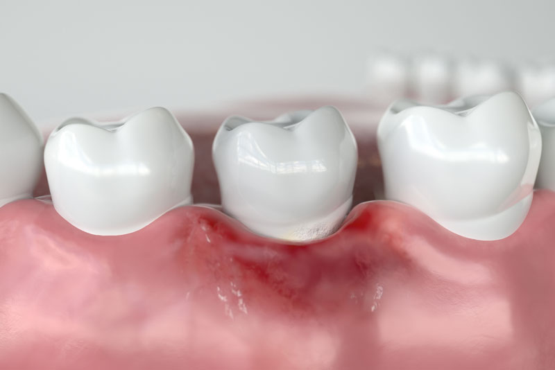 failing dental implant