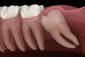 tooth extractions