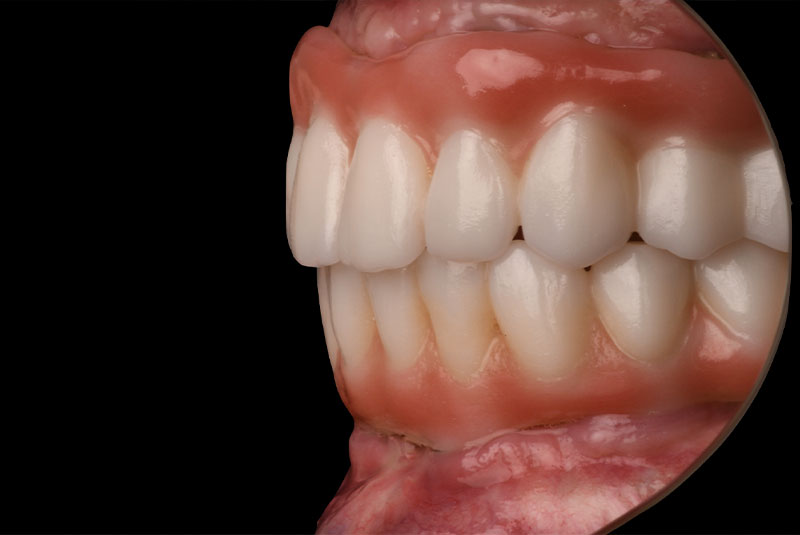 full arch dental implants model