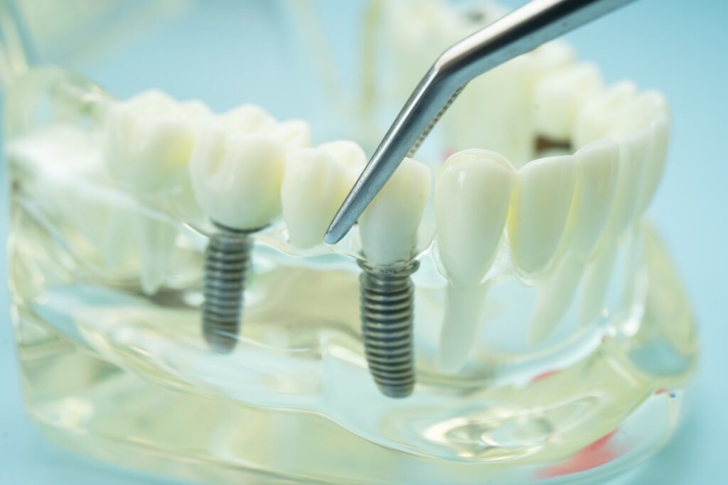 Dental Implant FAQ