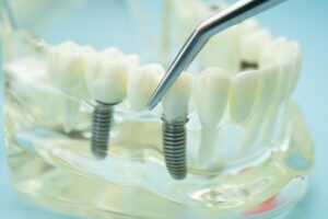 Dental Implant FAQ