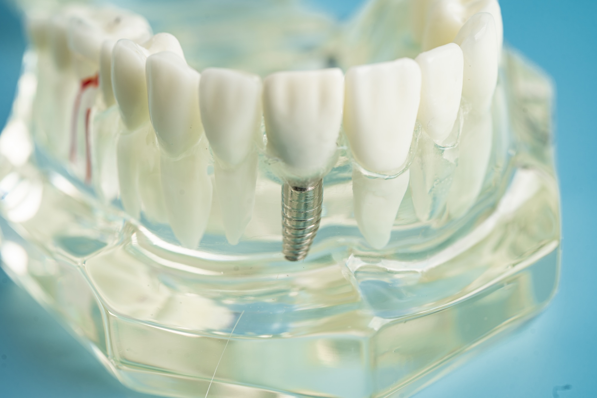 a single tooth implant