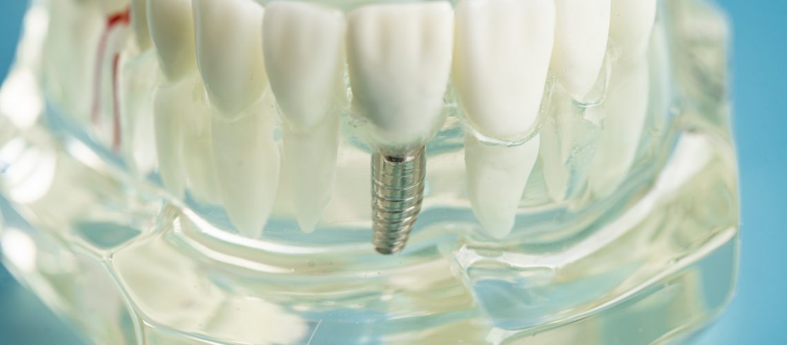 a single tooth implant