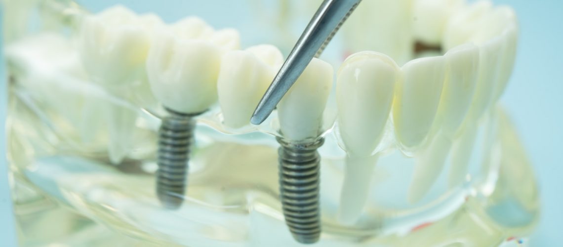 Image of a dental implant model for demonstration.